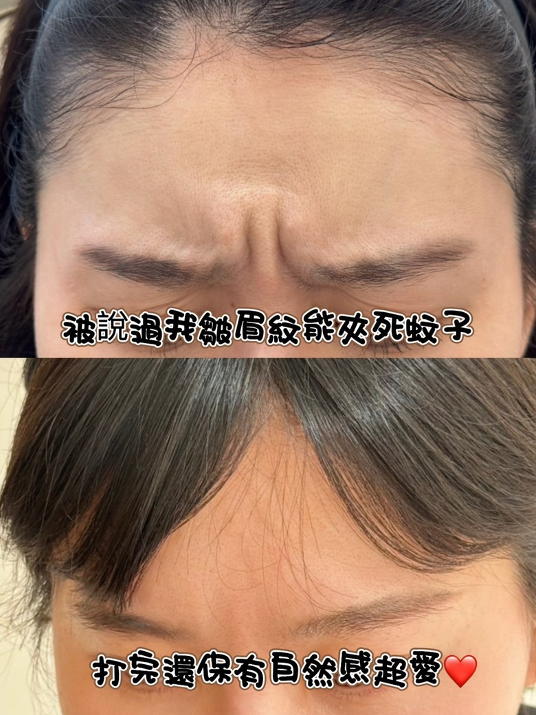 美國肉毒初體驗~抬頭紋消失了