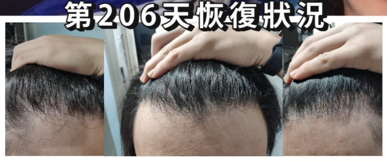 我植髮滿4年了！這一路的心得！當兵真的讓人看清很多事情！