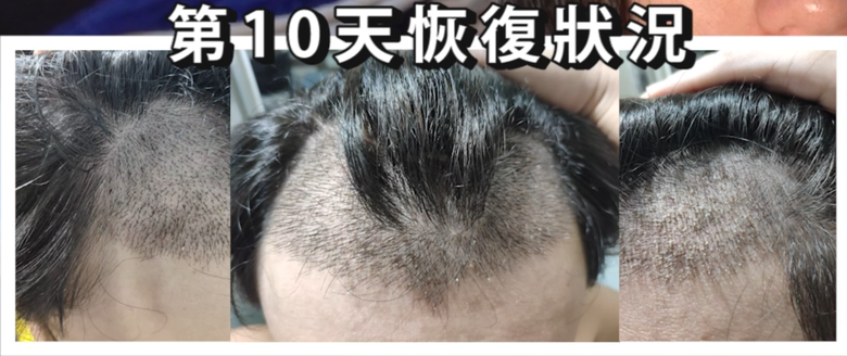 我植髮滿4年了！這一路的心得！當兵真的讓人看清很多事情！