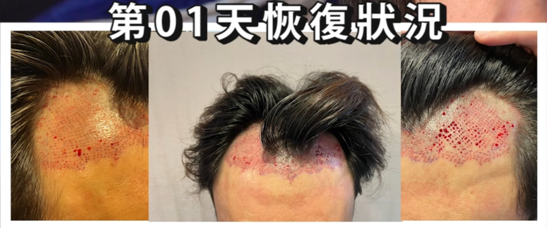 我植髮滿4年了！這一路的心得！當兵真的讓人看清很多事情！