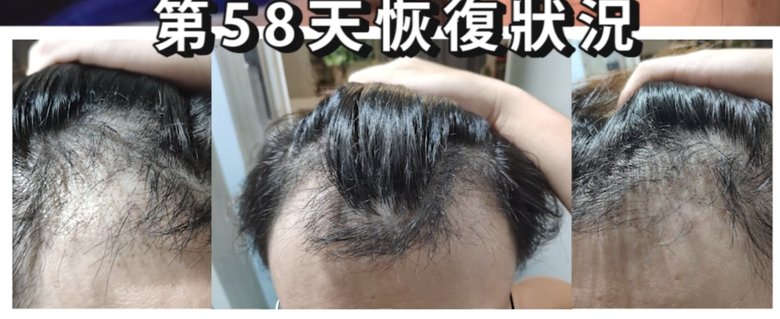 我植髮滿4年了！這一路的心得！當兵真的讓人看清很多事情！