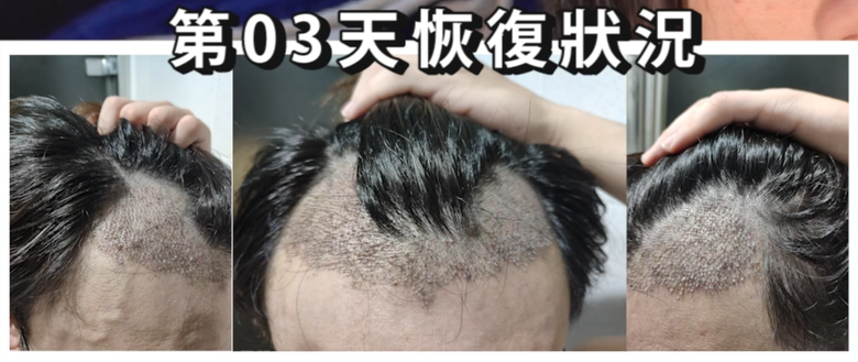 我植髮滿4年了！這一路的心得！當兵真的讓人看清很多事情！