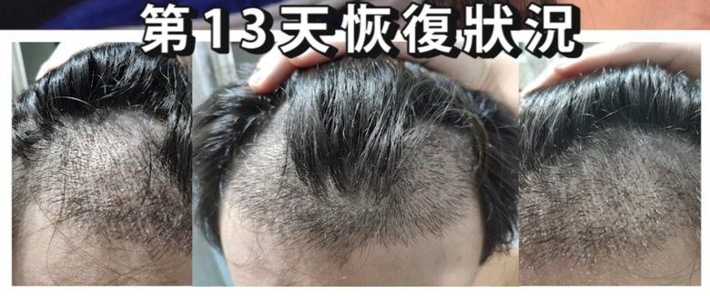 我植髮滿4年了！這一路的心得！當兵真的讓人看清很多事情！
