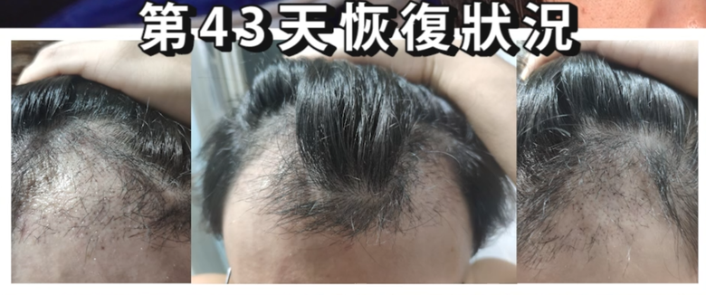 我植髮滿4年了！這一路的心得！當兵真的讓人看清很多事情！