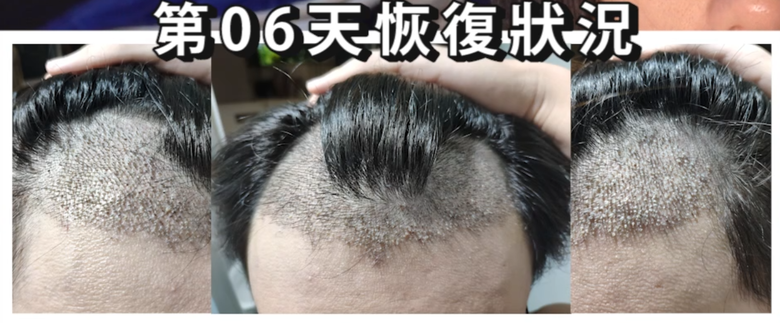 我植髮滿4年了！這一路的心得！當兵真的讓人看清很多事情！