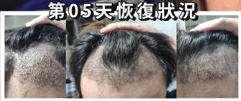 我植髮滿4年了！這一路的心得！當兵真的讓人看清很多事情！