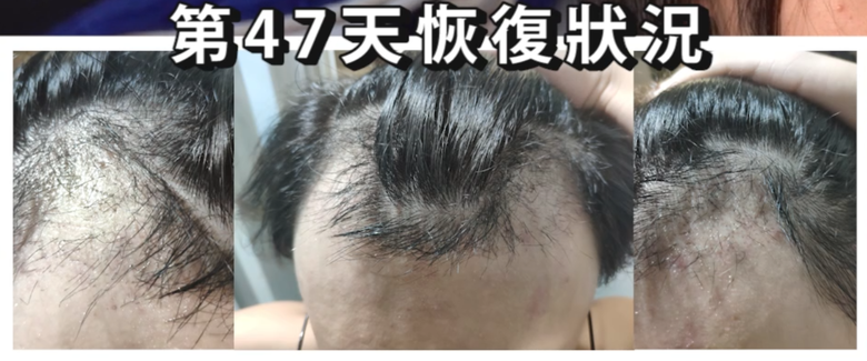 我植髮滿4年了！這一路的心得！當兵真的讓人看清很多事情！