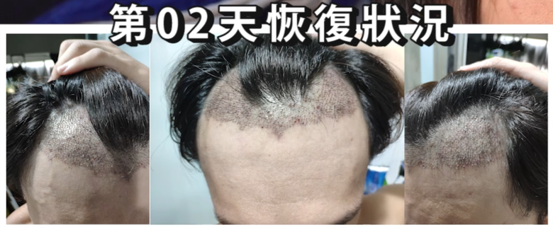 我植髮滿4年了！這一路的心得！當兵真的讓人看清很多事情！