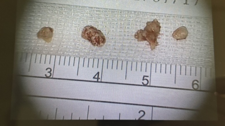 ［手術分享］唾液腺結石，奇特的病…
