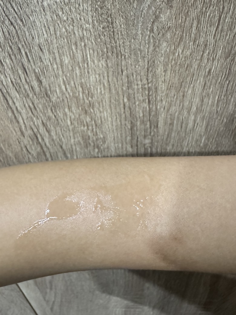 點我看大圖 小孩露營回來手腳起紅疹 處理經驗分享