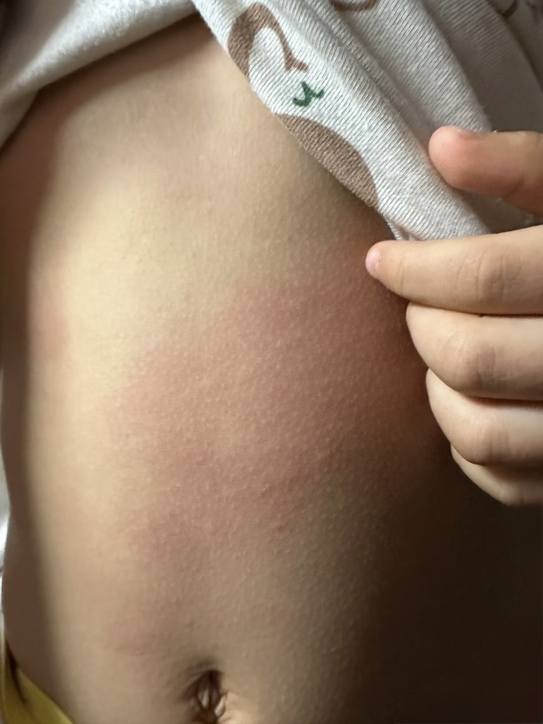 點我看大圖 小孩露營回來手腳起紅疹 處理經驗分享