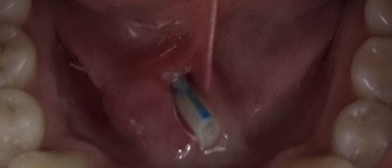 ［手術分享］唾液腺結石，奇特的病…