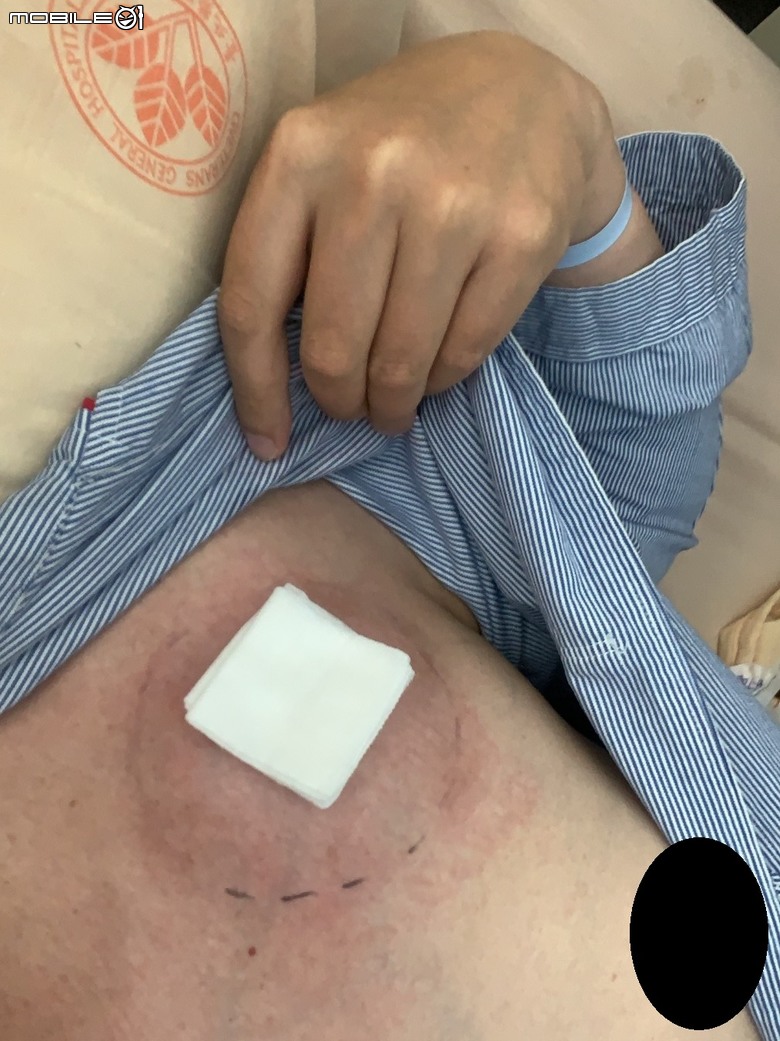 點我看大圖 「惡性軟組織肉瘤」完整治療紀錄(附實照,慎入)