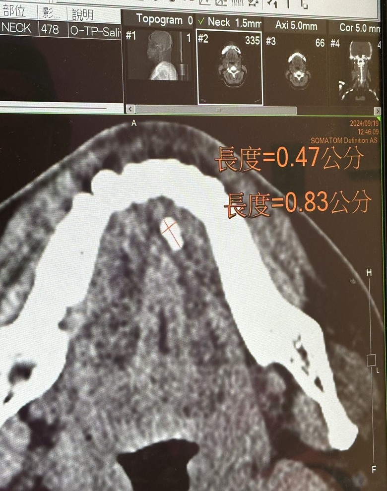 ［手術分享］唾液腺結石，奇特的病…