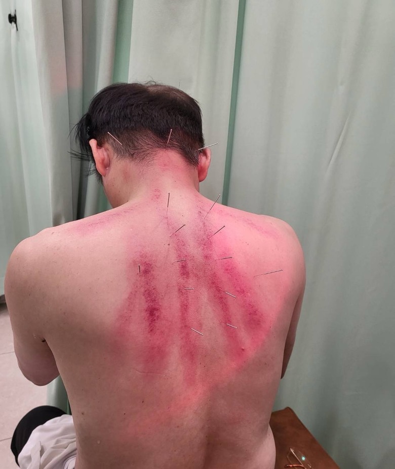 夏天中暑刮痧請益