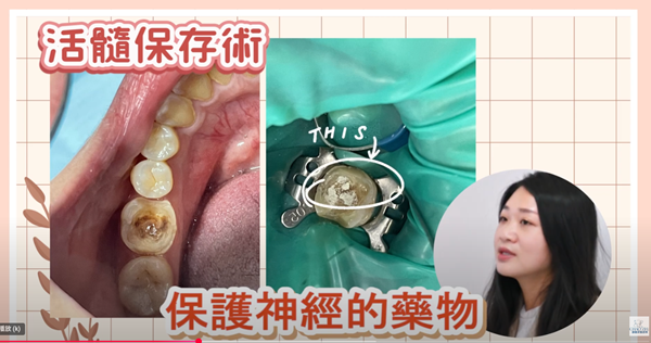 活隨保存術竟然救了大蛀牙