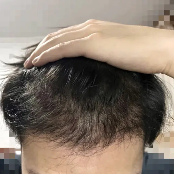 醫髮診所植髮大成功(台北植髮術後近一年分享)