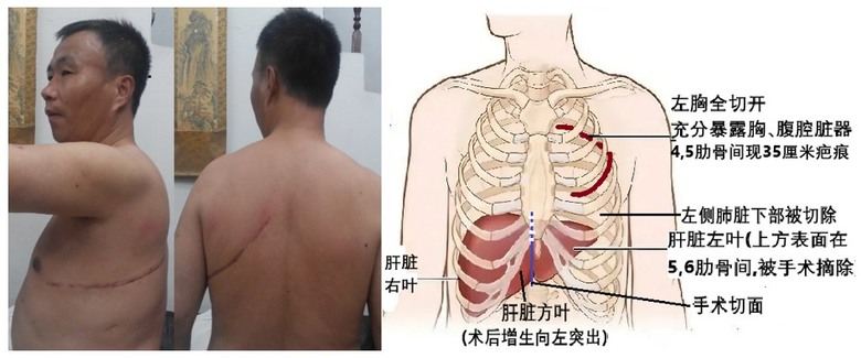 活摘倖存者：利用器官移植延壽 中共罪惡太大