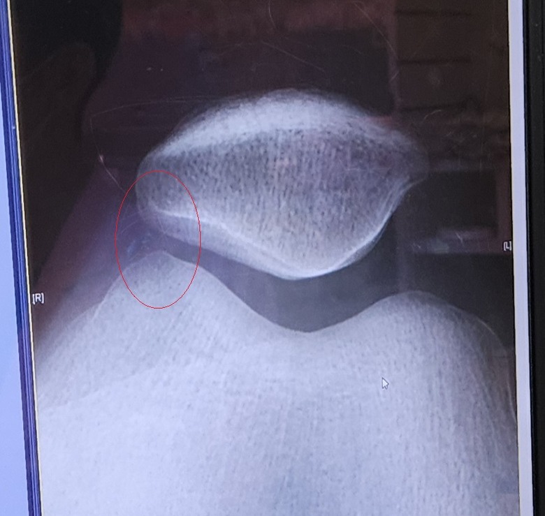 膝蓋問題，忘了問醫生，吃維骨力有效嗎