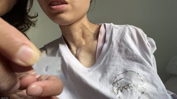 女子在中國被強摘器官 出走德國控訴中共