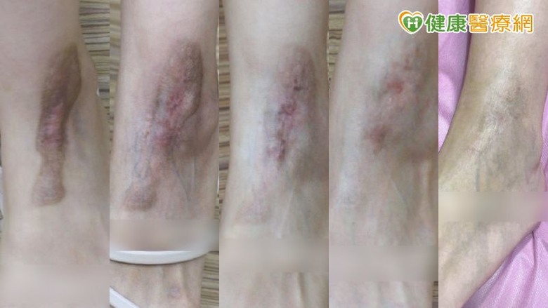 傷口癒合不是結束預防疤痕從「這時機」開始！醫揭疤痕凝膠應用策略