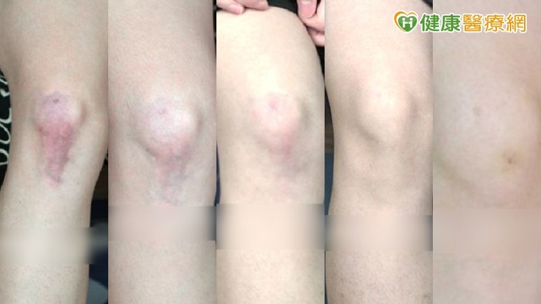傷口癒合不是結束預防疤痕從「這時機」開始！醫揭疤痕凝膠應用策略