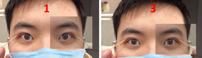 [請益]雙眼皮該怎麼選