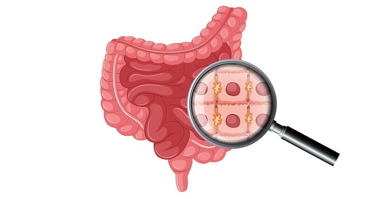 切除大腸息肉後，體內留著「止血夾」有關係嗎？