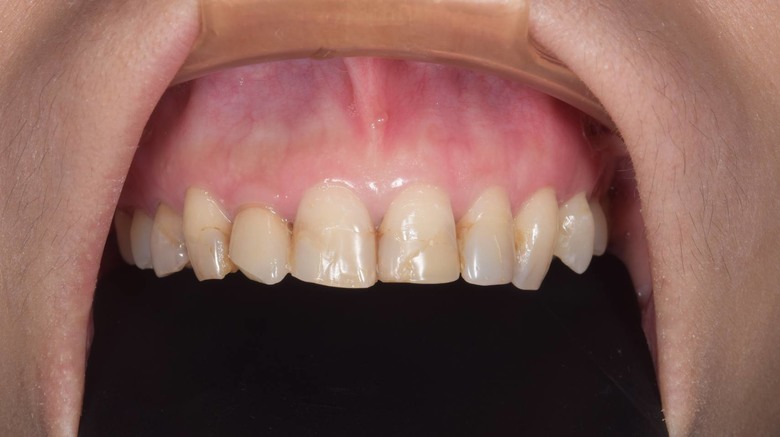 陶瓷貼片值得做嗎？做完貼片兩年半心得分享