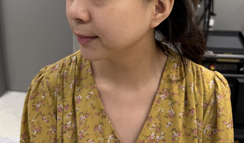 超神奇的Z音波體驗！！！！嬰兒肥真的不見啦（圖多）