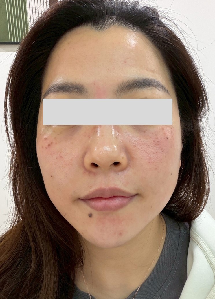 #分享 極光三效皮秒淡斑心得