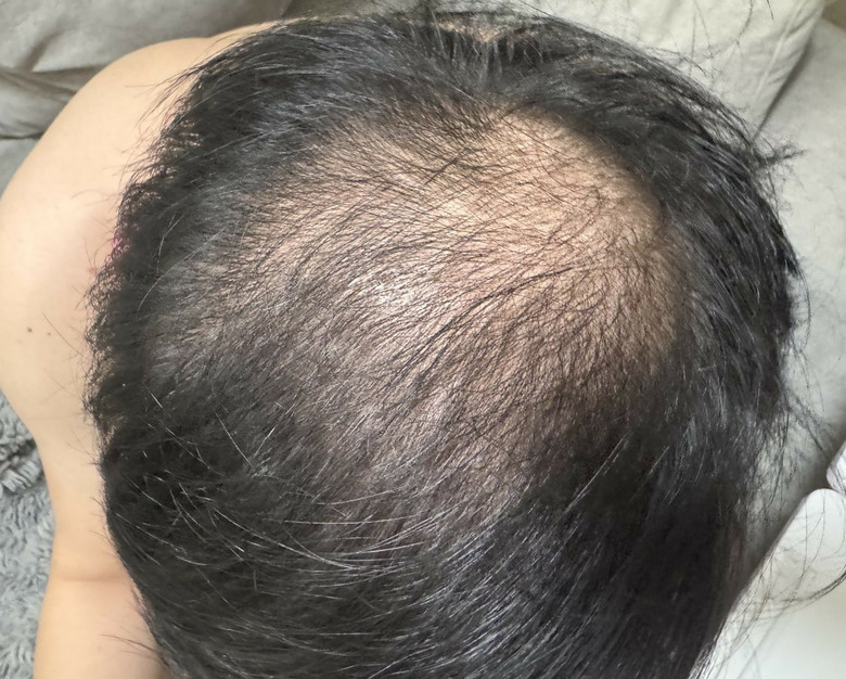 生髮帽到底是不是智商稅？iRESTORE生髮帽使用半年感想