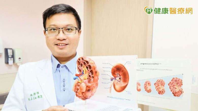 早期發現可延緩洗腎醫師：「這個」檢查可發現多囊腎