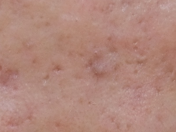 八年抗痘經驗 真的要看對的皮膚科
