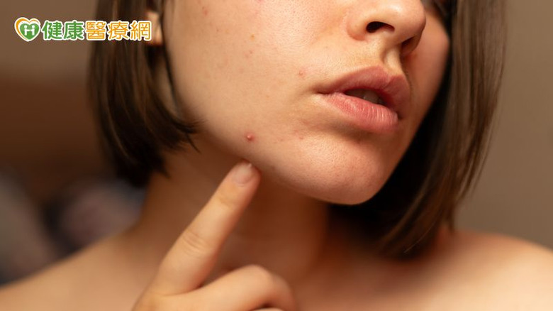 不只青春期！醫：痘痘也困擾上班族、更年期婦女研究揭僅3成就醫
