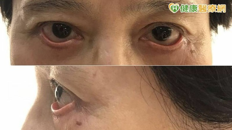 眼整形術後乾眼、閉眼困難？醫說明多元重建對策眼部結構修復是關鍵