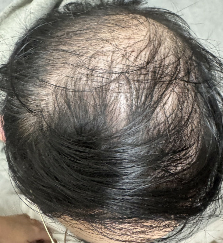生髮帽到底是不是智商稅？iRESTORE生髮帽使用半年感想