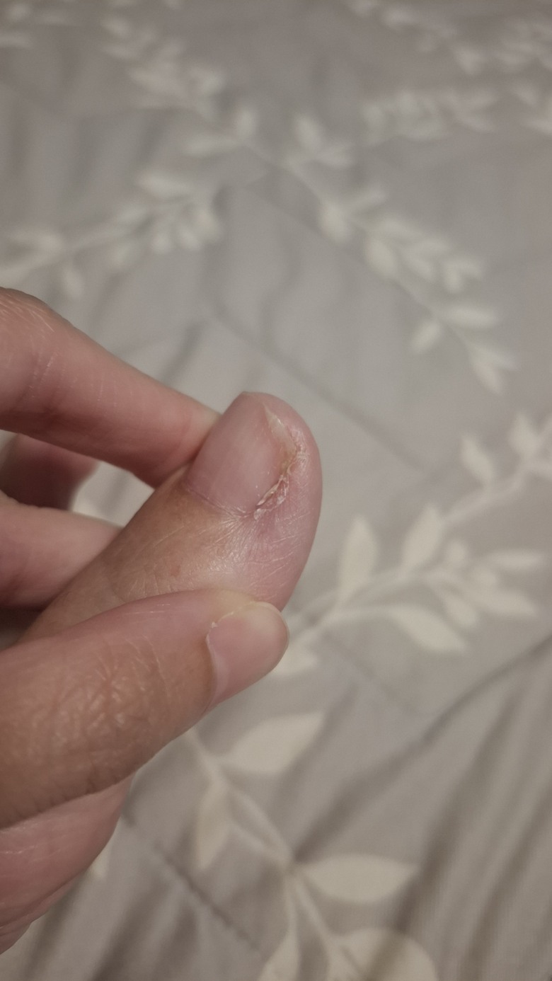 腳趾甲縫之前發炎，後來又增生這個是什麼？