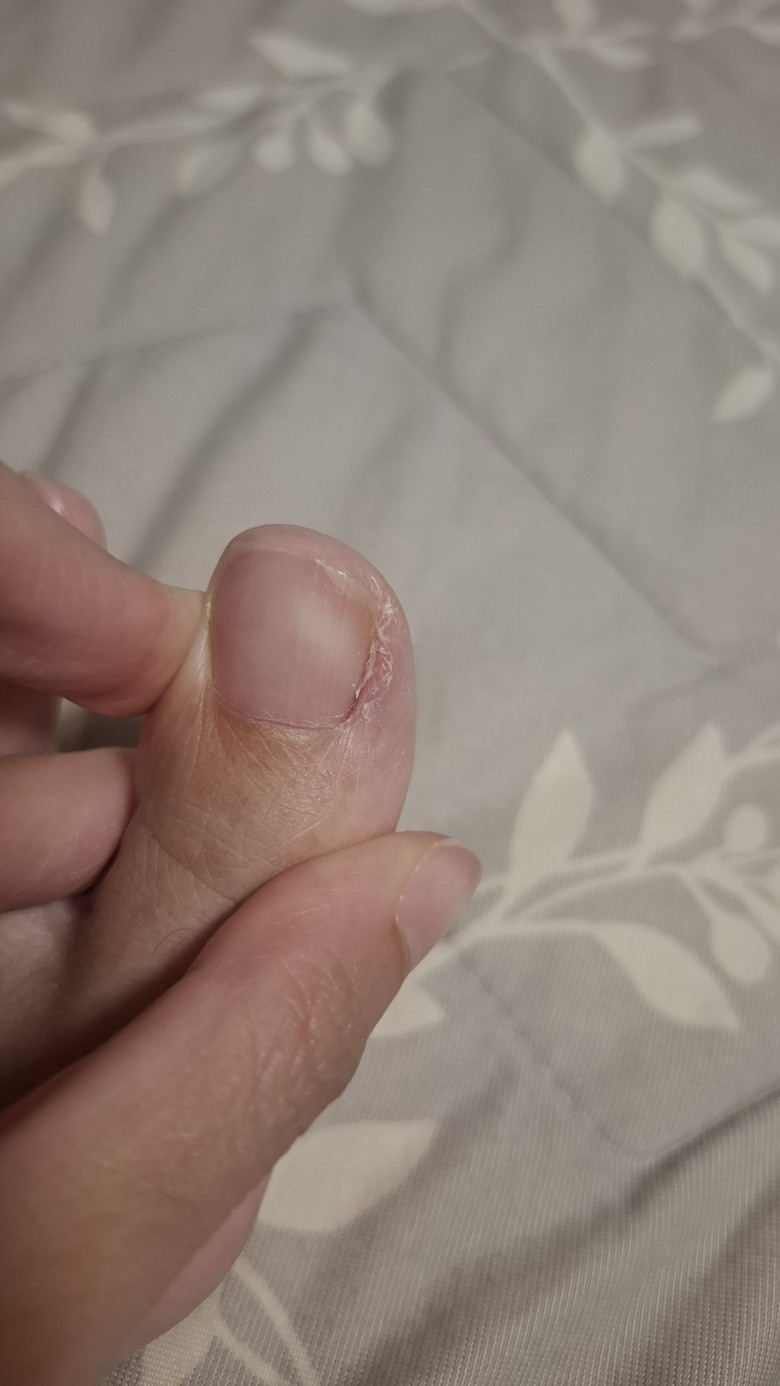 腳趾甲縫之前發炎，後來又增生這個是什麼？