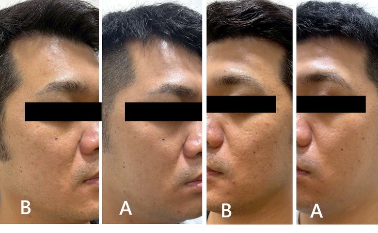 #心得 改善40歲的粗糙皮膚：神比微針電波療程分享