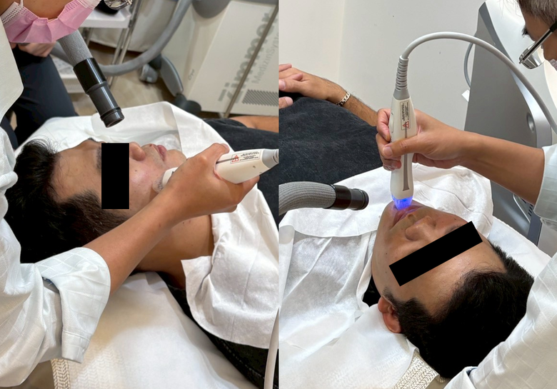 #心得 改善40歲的粗糙皮膚：神比微針電波療程分享