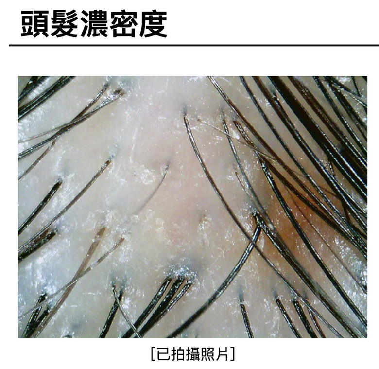 老婆說我頭髮感覺變多了，使用生予的洗髮精＋養髮液一年！（附前後頭皮檢測數據）