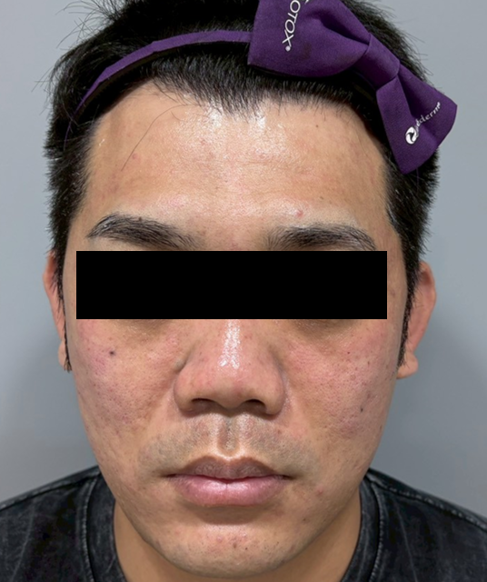 #心得 改善40歲的粗糙皮膚：神比微針電波療程分享