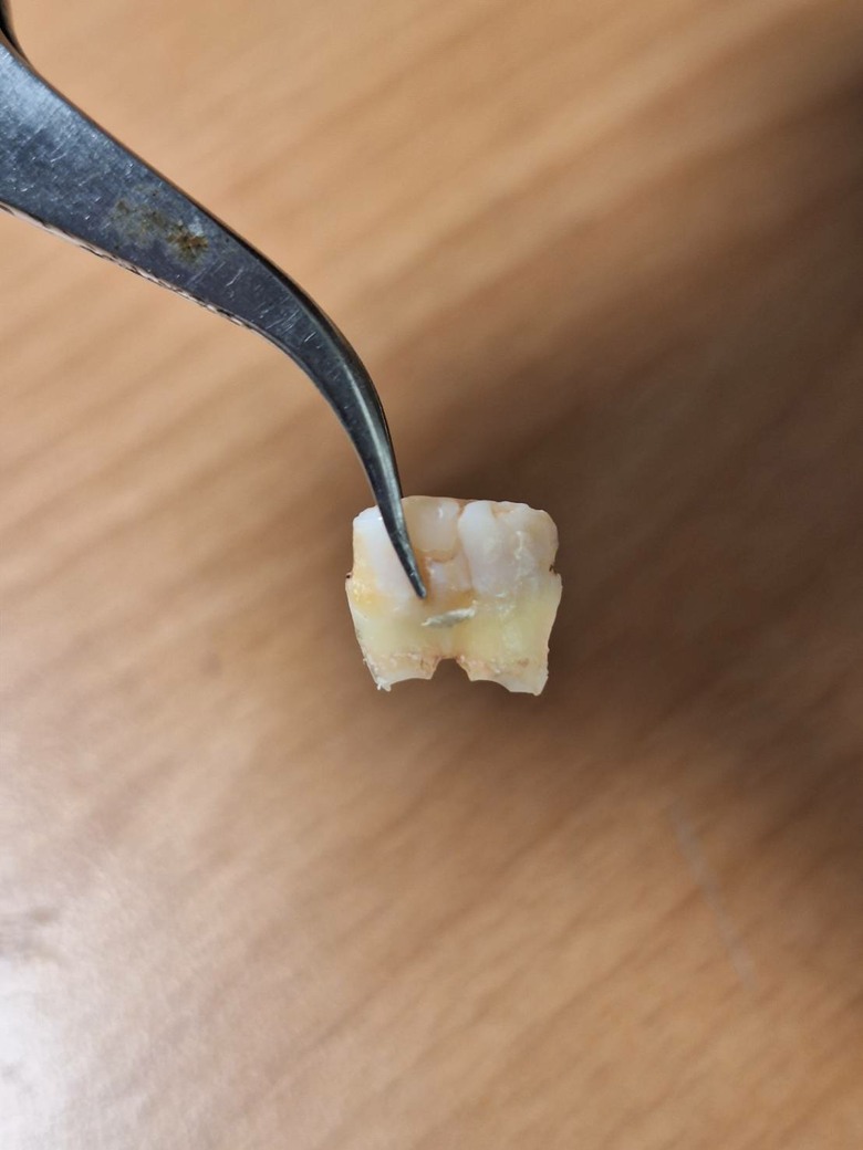 這顆牙還能留嗎(這是斷掉的部分)
