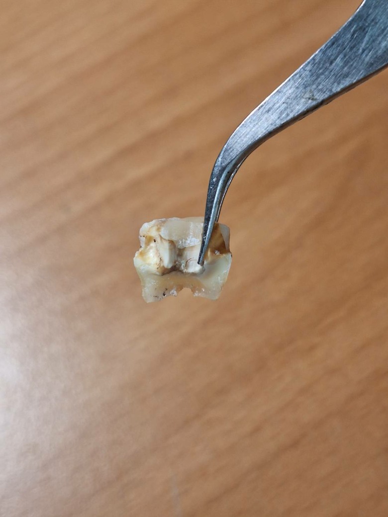 這顆牙還能留嗎(這是斷掉的部分)