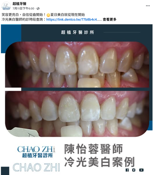 最近開始認真考慮牙齒美白了