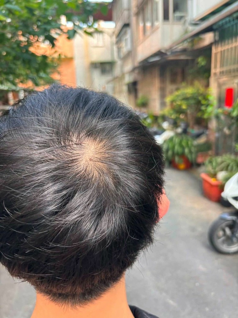就問30歲為什麼會禿頭?