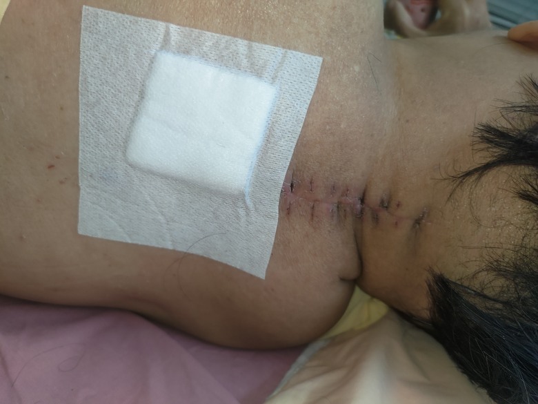 上次右眼開完白內障後接著2次頸椎神經壓迫和左眼白內障