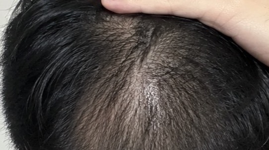 頭頂髮縫變明顯，落髮如何改善
