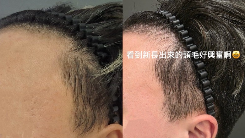 禿頭逆襲!這幾年真的沒少花錢